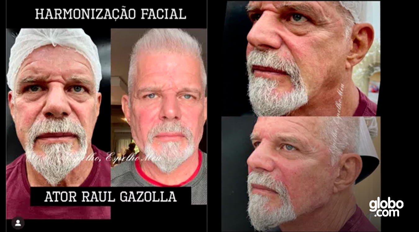 Harmonização facial em homens: veja o antes e depois de 10 famosos